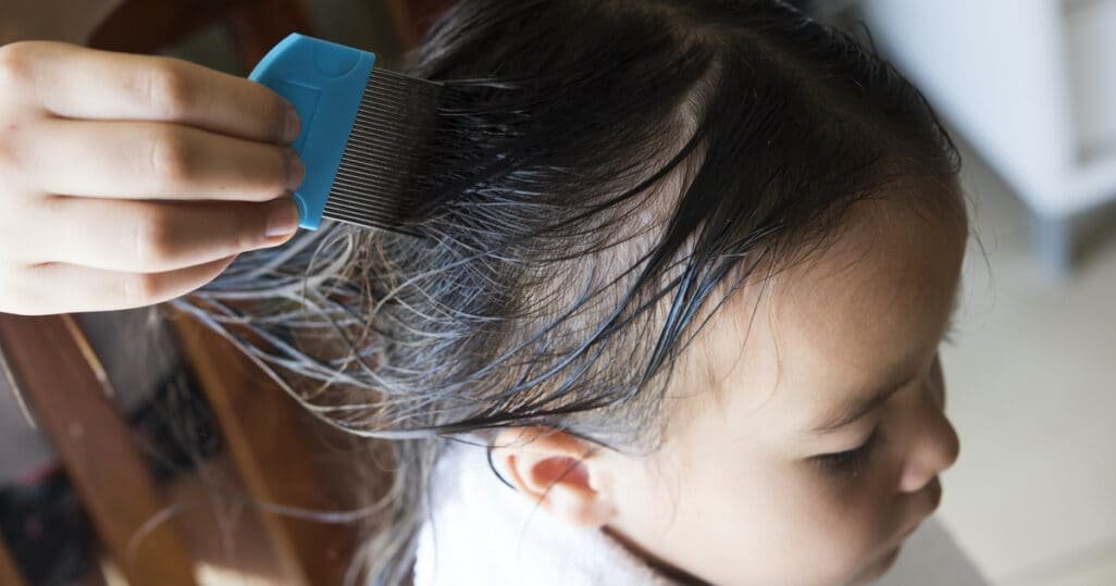 علاج قمل الرأس